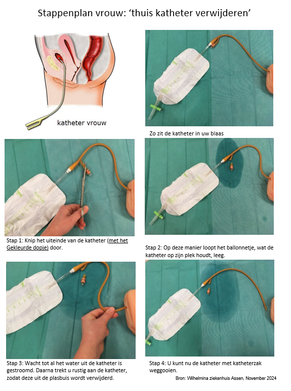 Stappenplan katheter verwijderen vrouw