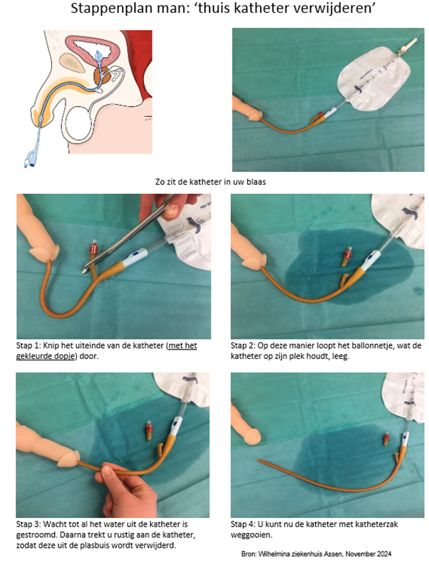 Stappenplan katheter verwijderen man