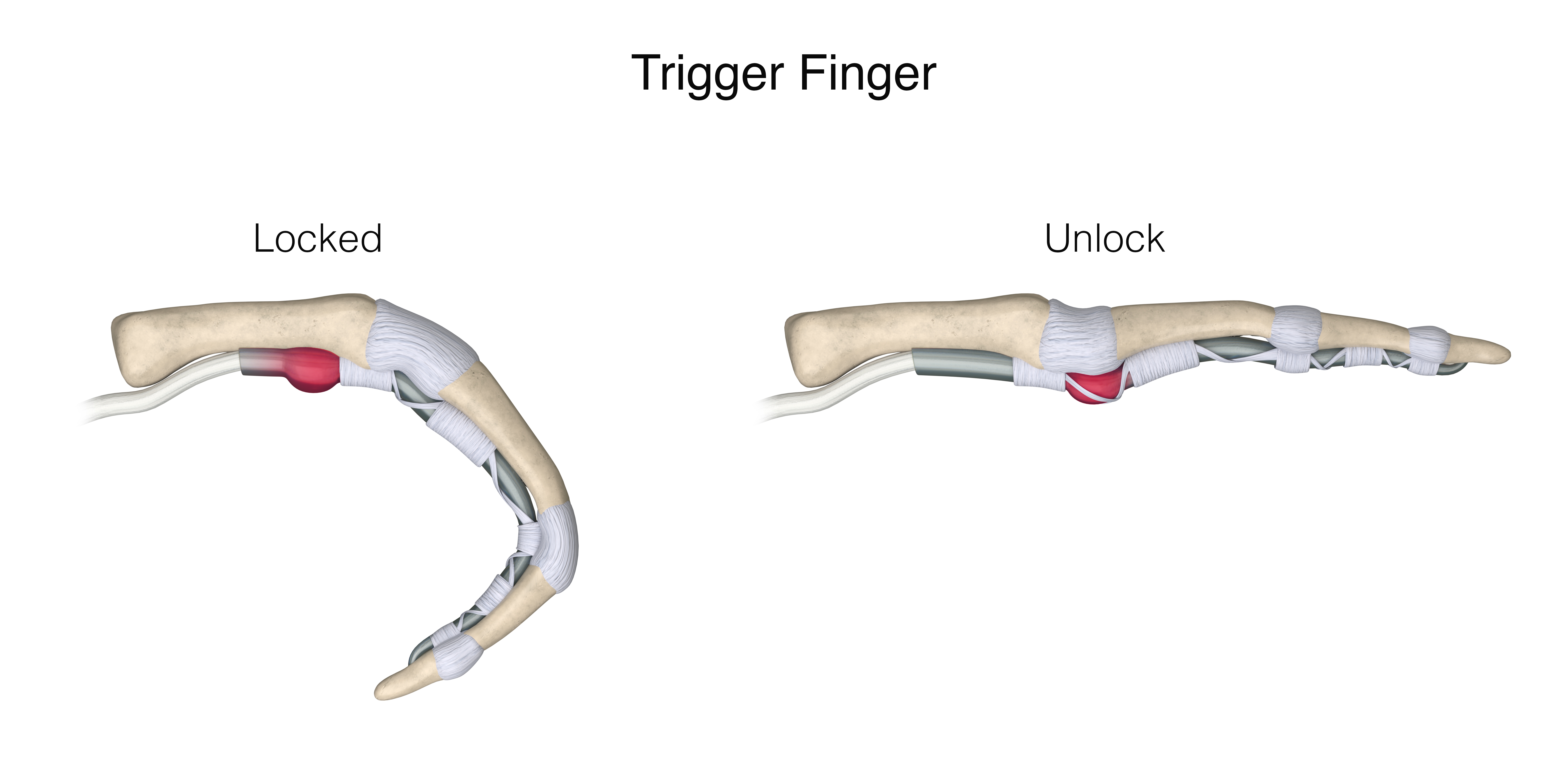 Tigger finger